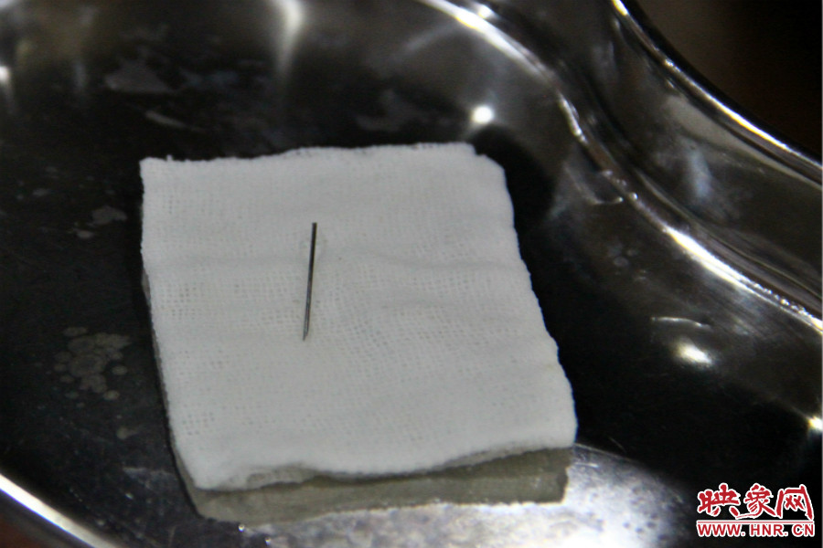 上午11點(diǎn)30分許，小龍腦中鋼針已經(jīng)成功取出。