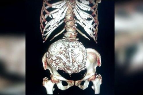 鈣化胎兒留在子宮超過半世紀(jì) 鈣化胎兒留在子宮超過半世紀(jì)