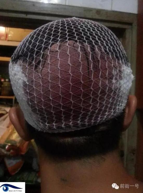 李律師受傷后縫合三針。