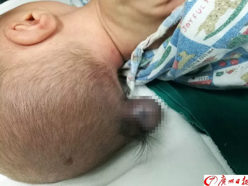 剛出生的男嬰腦袋上長(zhǎng)出尾巴 只因孕媽沒(méi)做這事 剛出生的男嬰腦袋上長(zhǎng)出尾巴 只因孕媽沒(méi)做這事