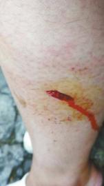 郭女士腿上被猴子咬的傷口。(受訪者供圖)